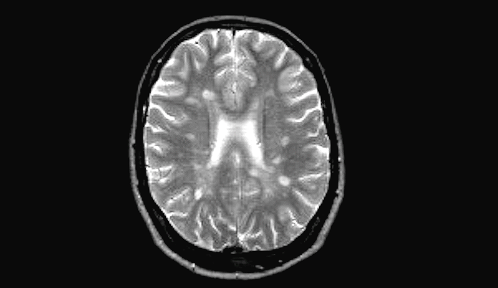  Multiple Sklerose: Gehirn mit typischen MS-Plaques Autor: DGN/Dr. Carsten Lukas, Bochum 
