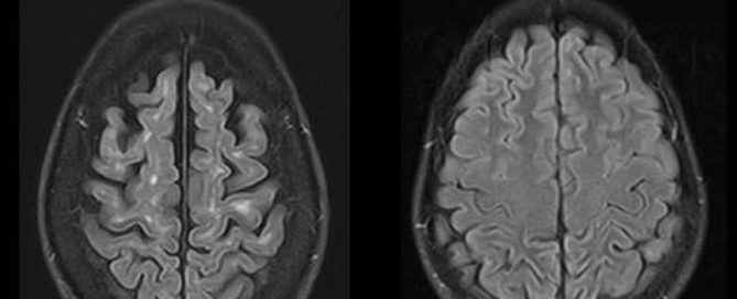 MRT-Aufnahmen des Gehirns eines MS-Patienten (A) und einer Kontrollperson (B), zur Veranschaulichung, wie sich die Erkrankung im Gehirn manifestiert: In (A) sichtbar die für die MS typischen weißen Läsionen nahe der Großhirnrinde sowie der Schwund (Atrophie) des Gehirns. Foto: Achim Gass (UMM)